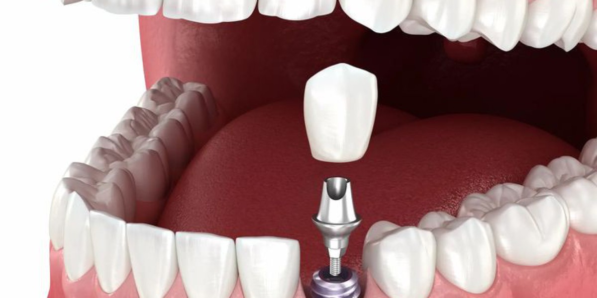 Modern Implant Dentistry Solutions for Permanent Tooth Replacement in Islamabad