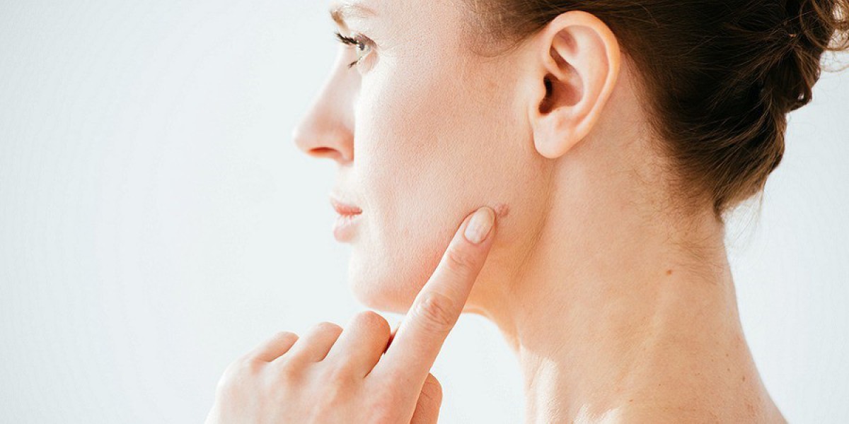 Can Mole Removal Improve My Skin?