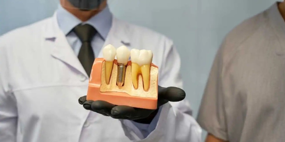 Is the Price Tag Worth It? A Realistic Breakdown of Dental Implant Costs