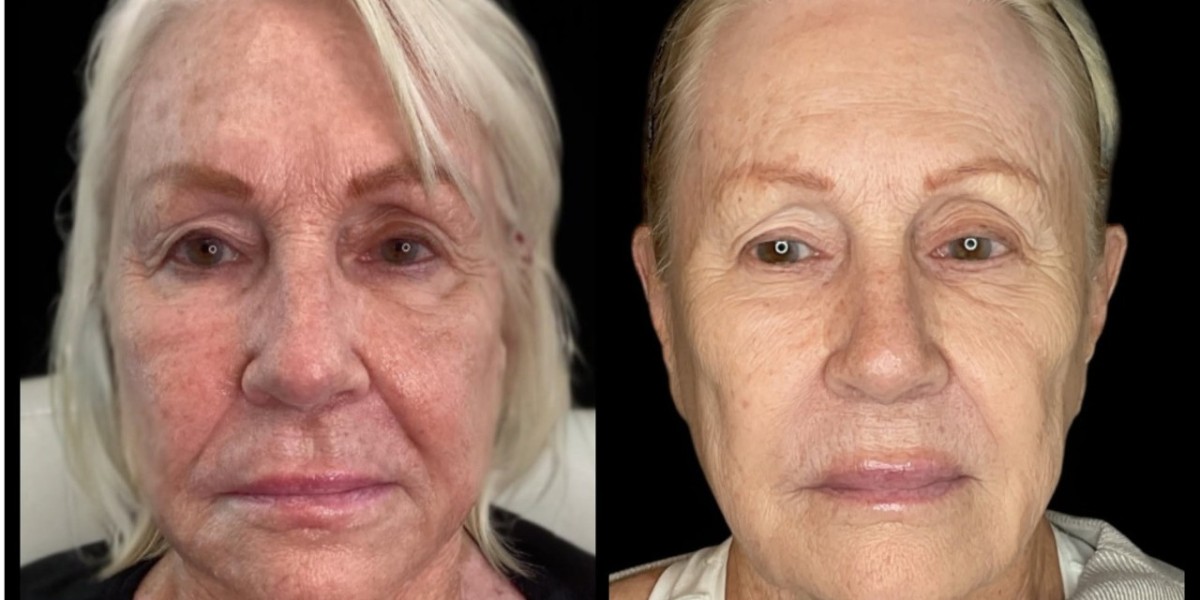 RF Microneedling Boynton Beach: Advanced Skin Rejuvenation for a Smoother Look
